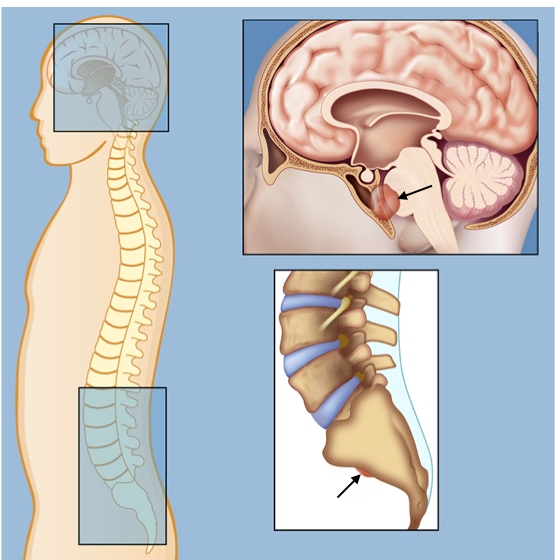 Remnants of notochord can develop into a slow growing tumor called a chordoma.