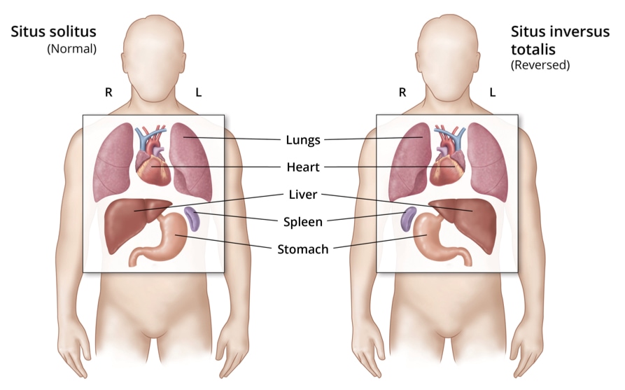 Mutations in notochord cilia lead to situs inversus.